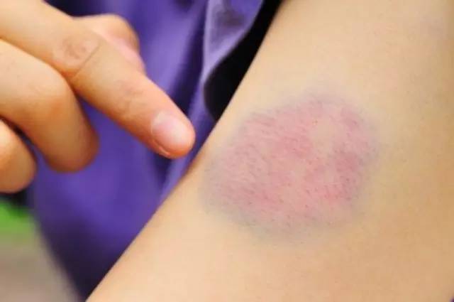 Life question: blue and purple, why does the bruise change color?